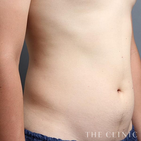 腹部の360脂肪吸引®（22歳男性）の術前写真
