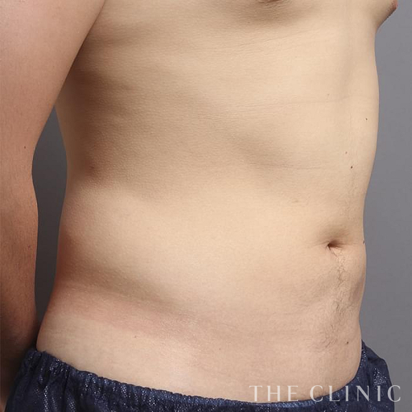 腹部の360脂肪吸引®（22歳男性）の術後写真