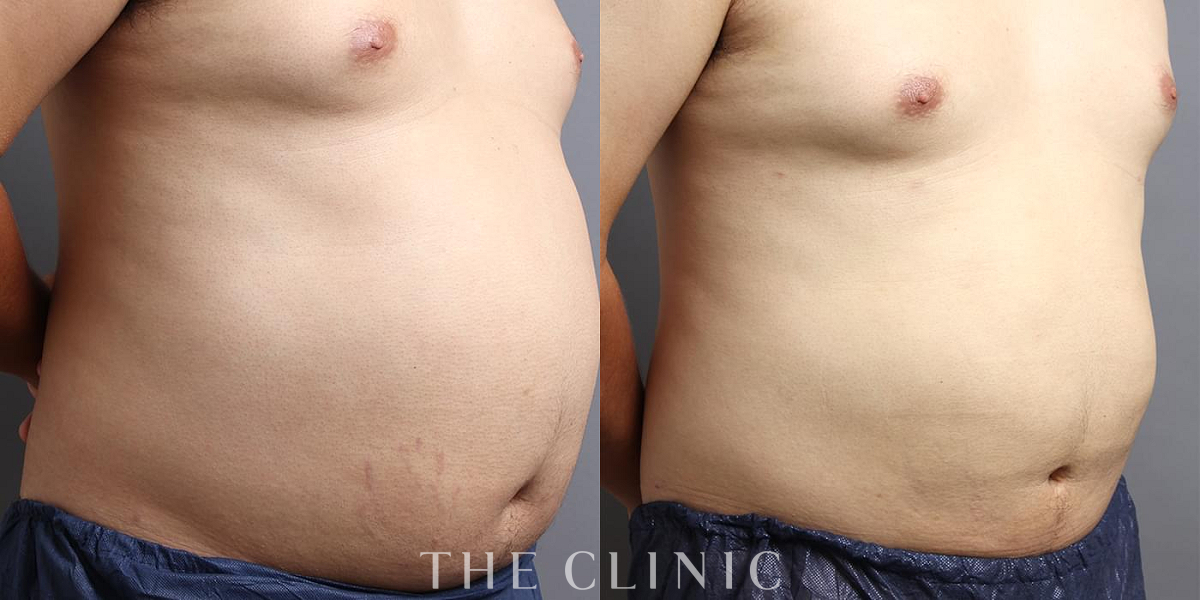 360脂肪吸引®の術前／術後