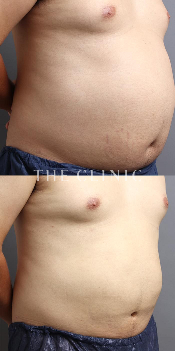 腹部の360脂肪吸引®（29歳男性）の術前・術後写真