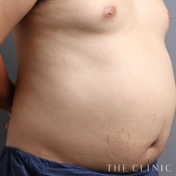 腹部の360脂肪吸引®（29歳男性）の術前写真