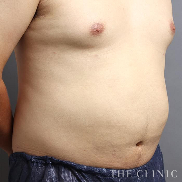 腹部の360脂肪吸引®（29歳男性）の術後写真