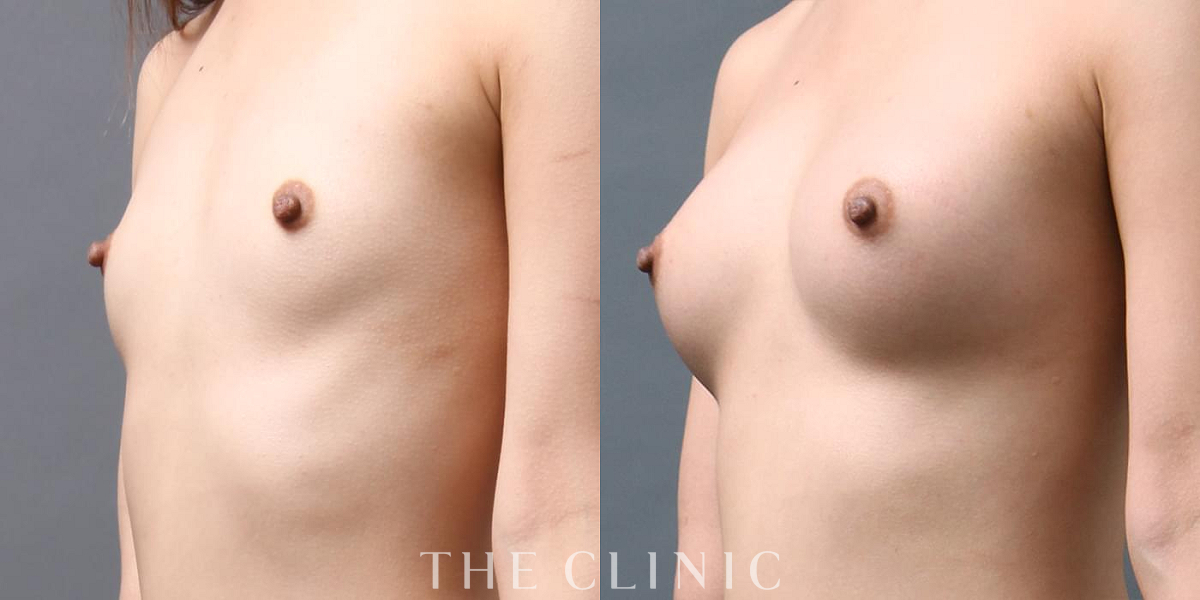 コンデンスリッチ豊胸の術前/術後