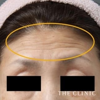 【THE CLINIC 症例画像】No.380_1_額のシワ_マイクロCRF注入(顔の脂肪注入)(執刀医:大橋 昌敬)