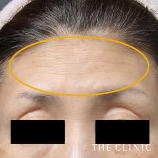 【THE CLINIC 症例画像】No.380_2_額のシワ_マイクロCRF注入(顔の脂肪注入)(執刀医:大橋 昌敬)