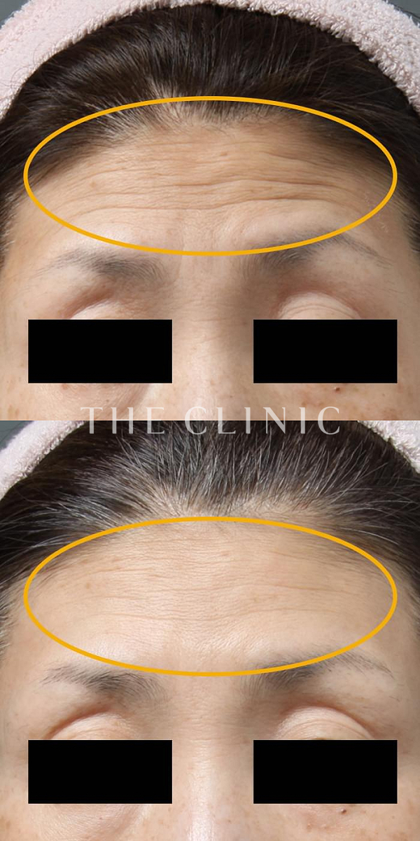 額のシワのマイクロCRF注入(顔の脂肪注入)（39歳女性）の術前・術後写真