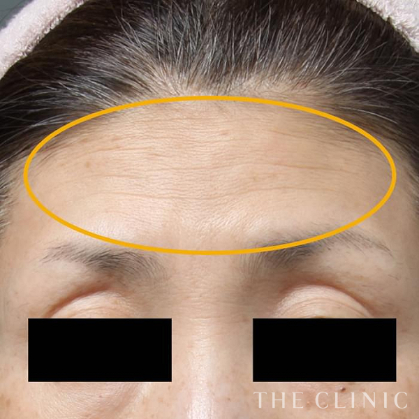額のシワのマイクロCRF注入(顔の脂肪注入)（39歳女性）の術後写真