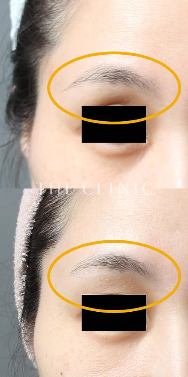 目の上のくぼみのマイクロCRF注入(顔の脂肪注入)（39歳女性）の術前・術後写真