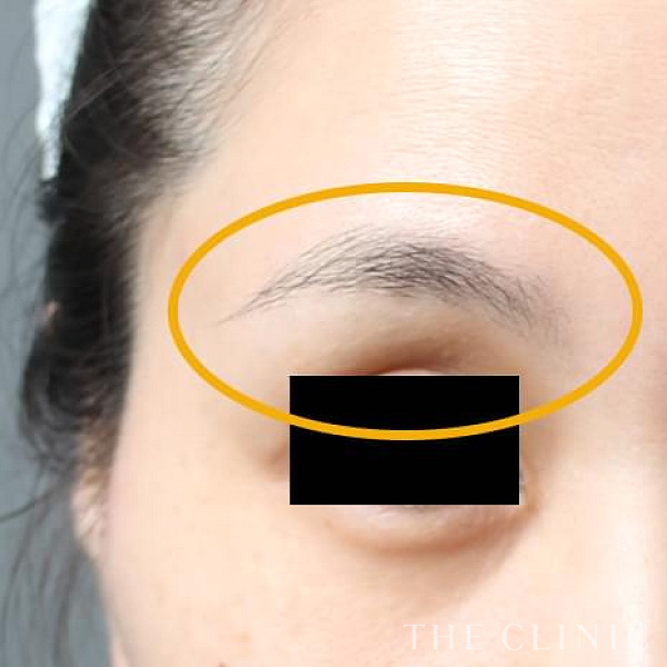 目の上のくぼみのマイクロCRF注入(顔の脂肪注入)（39歳女性）の術前写真