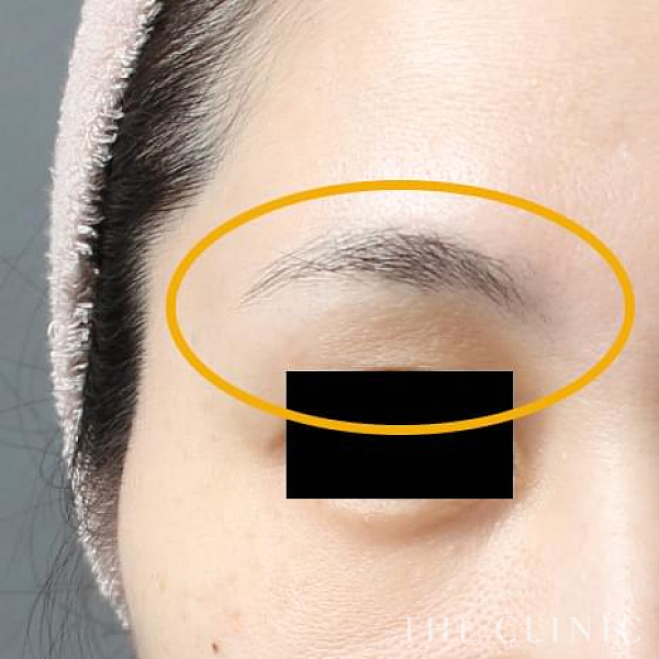 目の上のくぼみのマイクロCRF注入(顔の脂肪注入)（39歳女性）の術後写真