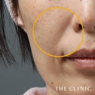 法令線のマイクロCRF注入(顔の脂肪注入)のモニター(30代)術前症例画像