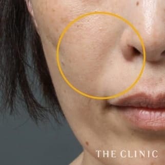 法令線のマイクロCRF注入(顔の脂肪注入)のモニター(30代)術後症例画像