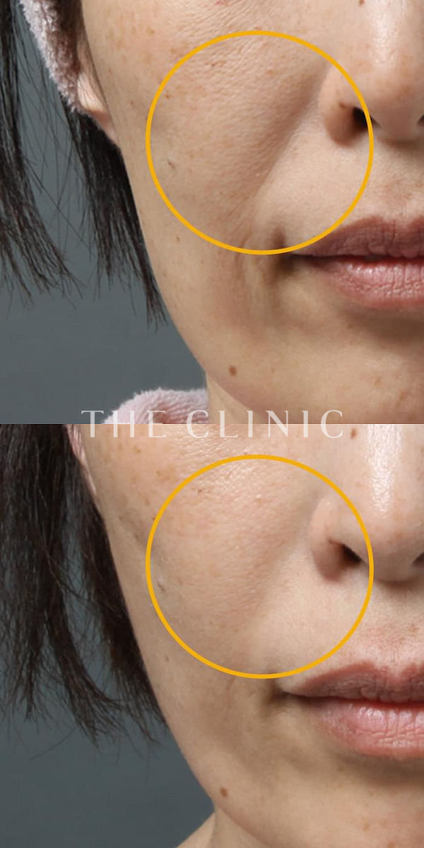 法令線のマイクロCRF注入(顔の脂肪注入)（39歳女性）の術前・術後写真