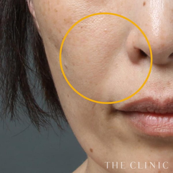 法令線のマイクロCRF注入(顔の脂肪注入)（39歳女性）の術後写真