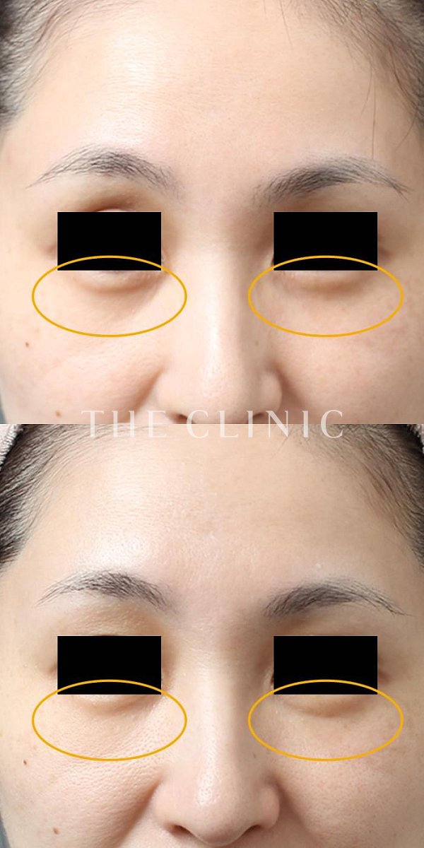 目の下のクマのマイクロCRF注入(顔の脂肪注入)（39歳女性）の術前・術後写真