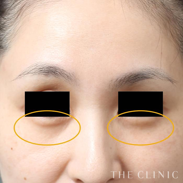 目の下のクマのマイクロCRF注入(顔の脂肪注入)（39歳女性）の術前写真