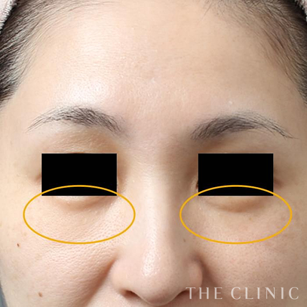 目の下のクマのマイクロCRF注入(顔の脂肪注入)（39歳女性）の術後写真