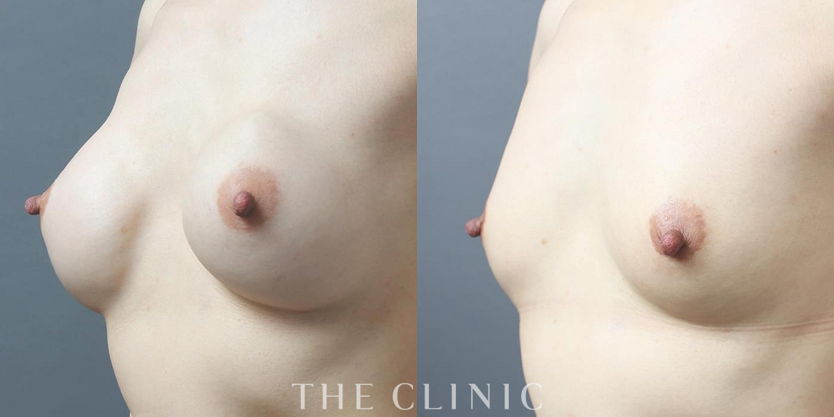 コンデンスリッチ豊胸の術前／術後