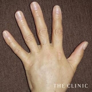 【THE CLINIC 症例画像】No.394_2_手のシワ_手の甲への脂肪注入(ハンドリバイブ)