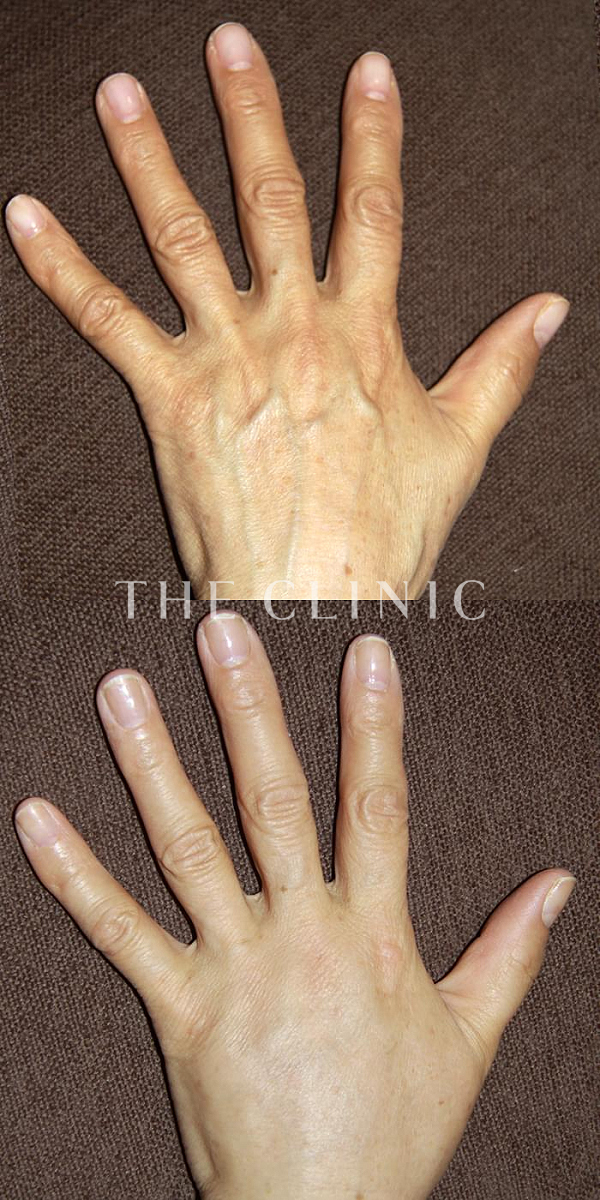 手のシワの手の甲への脂肪注入(ハンドリバイブ)（54歳女性）の術前・術後写真