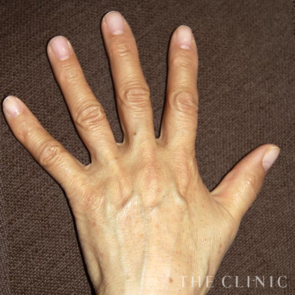 手のシワの手の甲への脂肪注入(ハンドリバイブ)（54歳女性）の術前写真