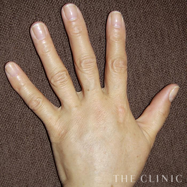 手のシワの手の甲への脂肪注入(ハンドリバイブ)（54歳女性）の術後写真