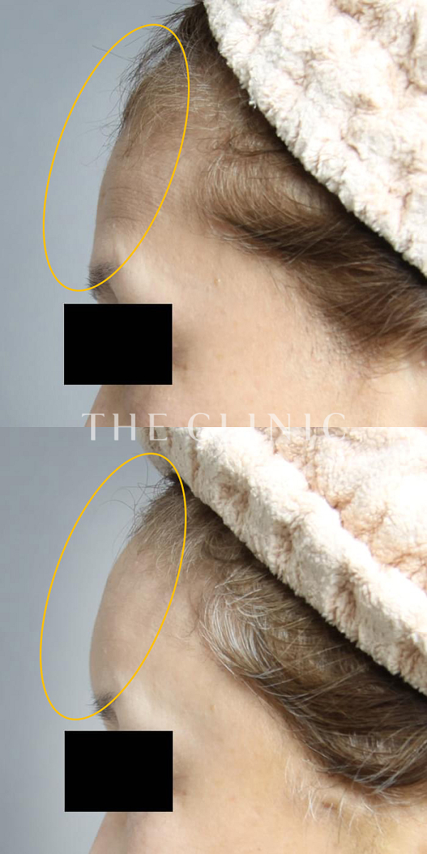 額のシワのコンデンスリッチフェイス(顔の脂肪注入)（57歳女性）の術前・術後写真