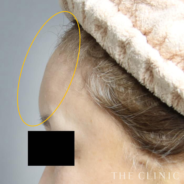 額のシワのコンデンスリッチフェイス(顔の脂肪注入)（57歳女性）の術後写真