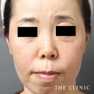 目尻のシワのマイクロCRF注入(顔の脂肪注入)のモニター(30代)術前症例画像