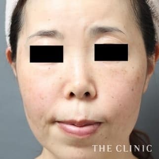 目尻のシワのマイクロCRF注入(顔の脂肪注入)のモニター(30代)術後症例画像