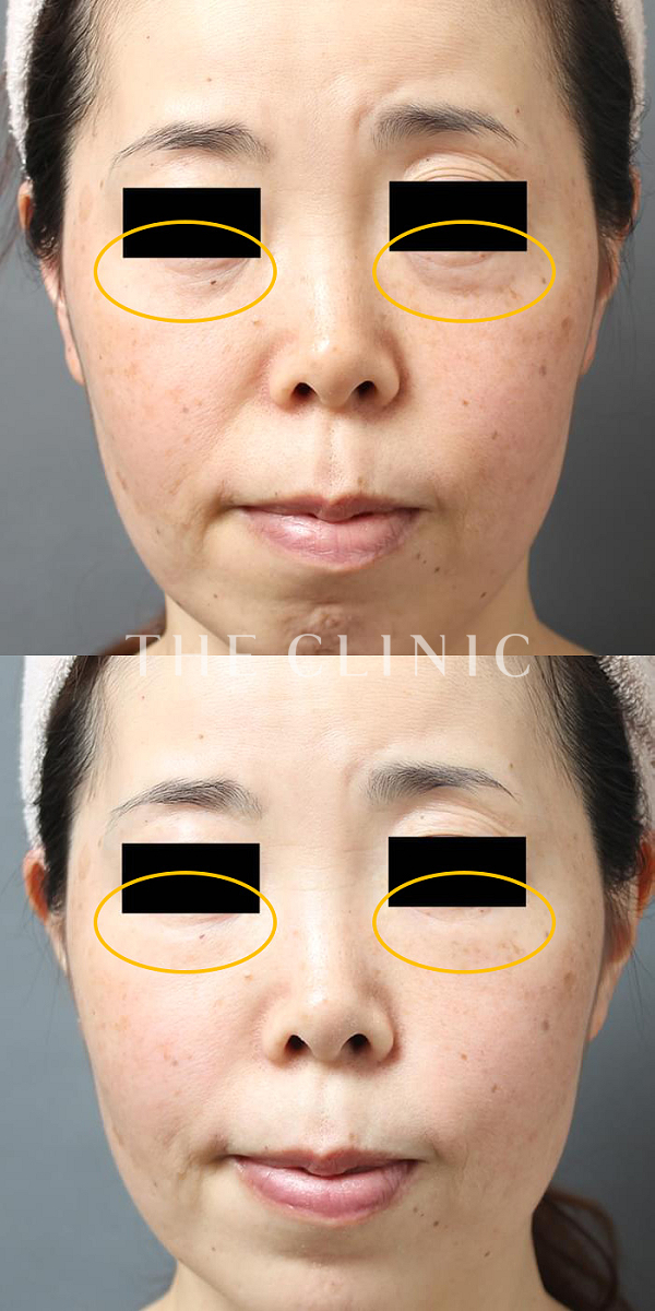 目尻のシワのマイクロCRF注入(顔の脂肪注入)（39歳女性）の術前・術後写真