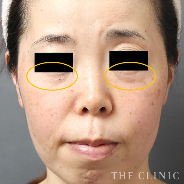 目尻のシワのマイクロCRF注入(顔の脂肪注入)（39歳女性）の術前写真