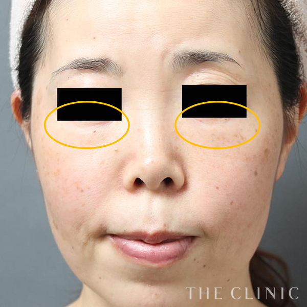 目尻のシワのマイクロCRF注入(顔の脂肪注入)（39歳女性）の術後写真