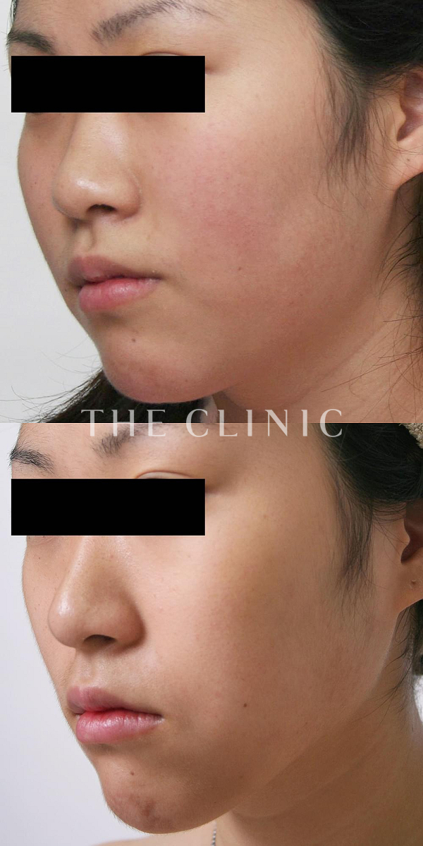 頰／顎のベイザー脂肪吸引（25歳女性）の術前・術後写真