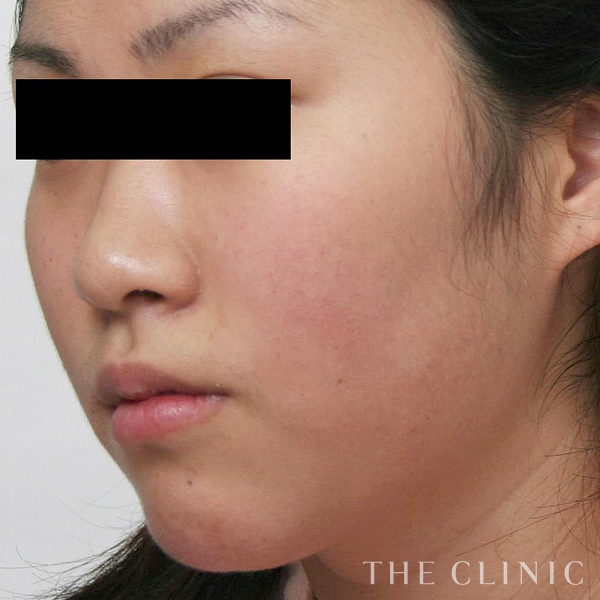 頰／顎のベイザー脂肪吸引（25歳女性）の術前写真