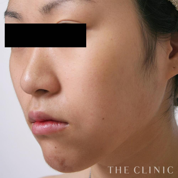 頰／顎のベイザー脂肪吸引（25歳女性）の術後写真