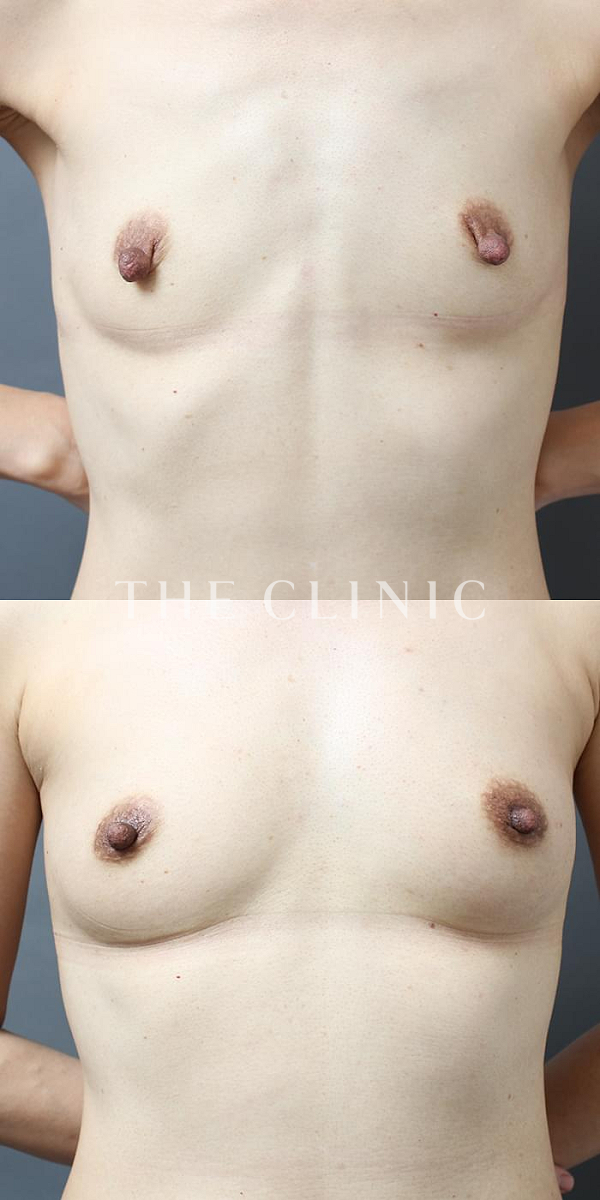 ボリュームアップのコンデンスリッチ豊胸（47歳女性）の術前・術後写真