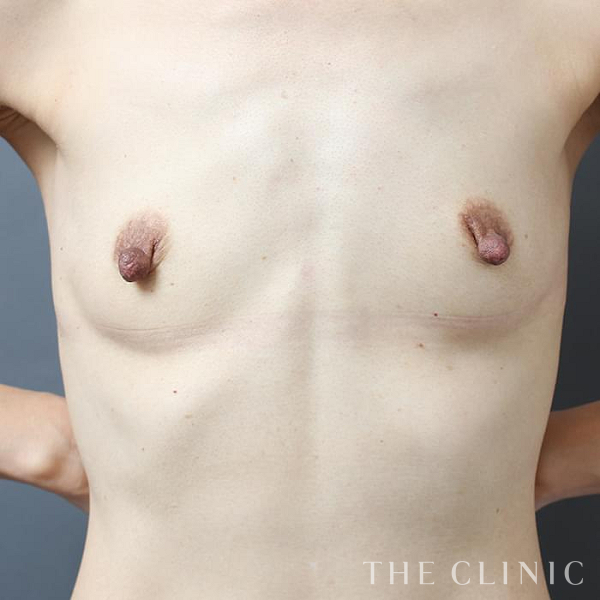 ボリュームアップのコンデンスリッチ豊胸（47歳女性）の術前写真