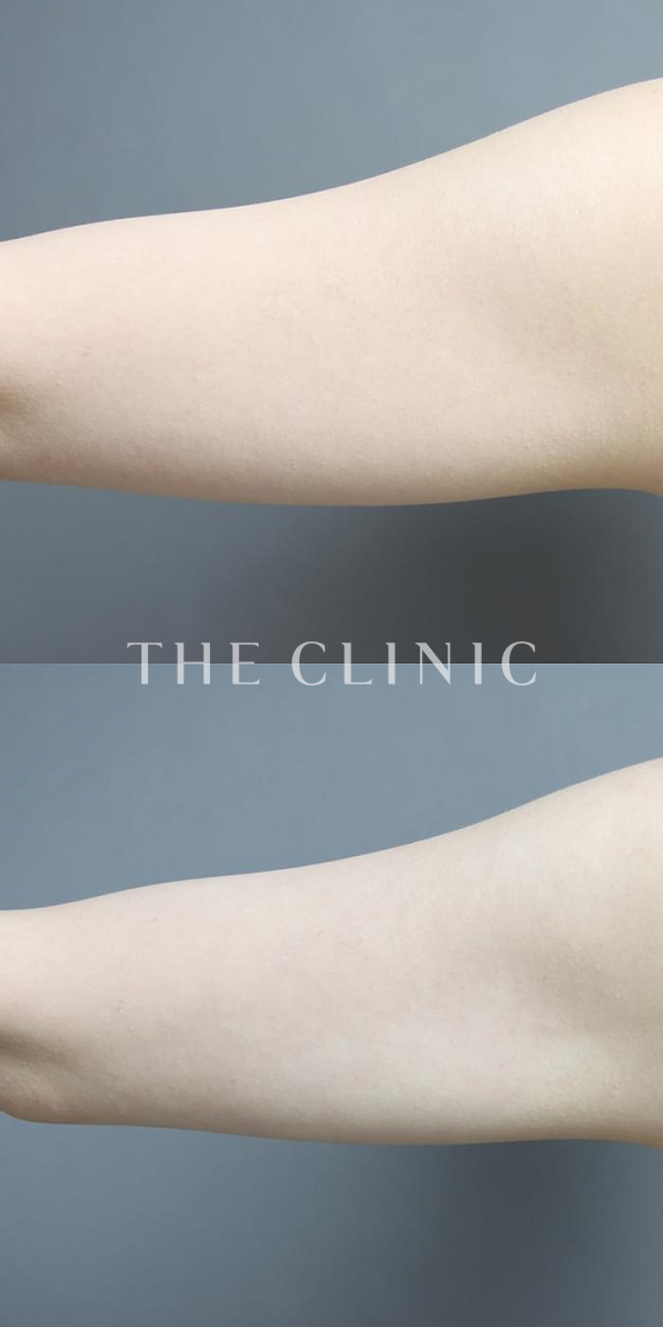 二の腕のベイザー脂肪吸引（26歳女性）の術前・術後写真