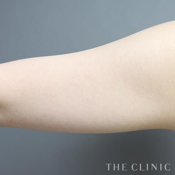 二の腕のベイザー脂肪吸引（26歳女性）の術前写真