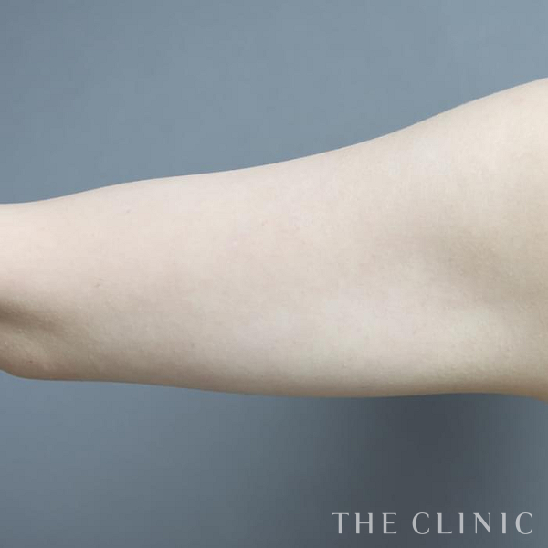 二の腕のベイザー脂肪吸引（26歳女性）の術後写真
