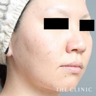頰／顎のベイザー脂肪吸引のモニター（30代）術後症例画像