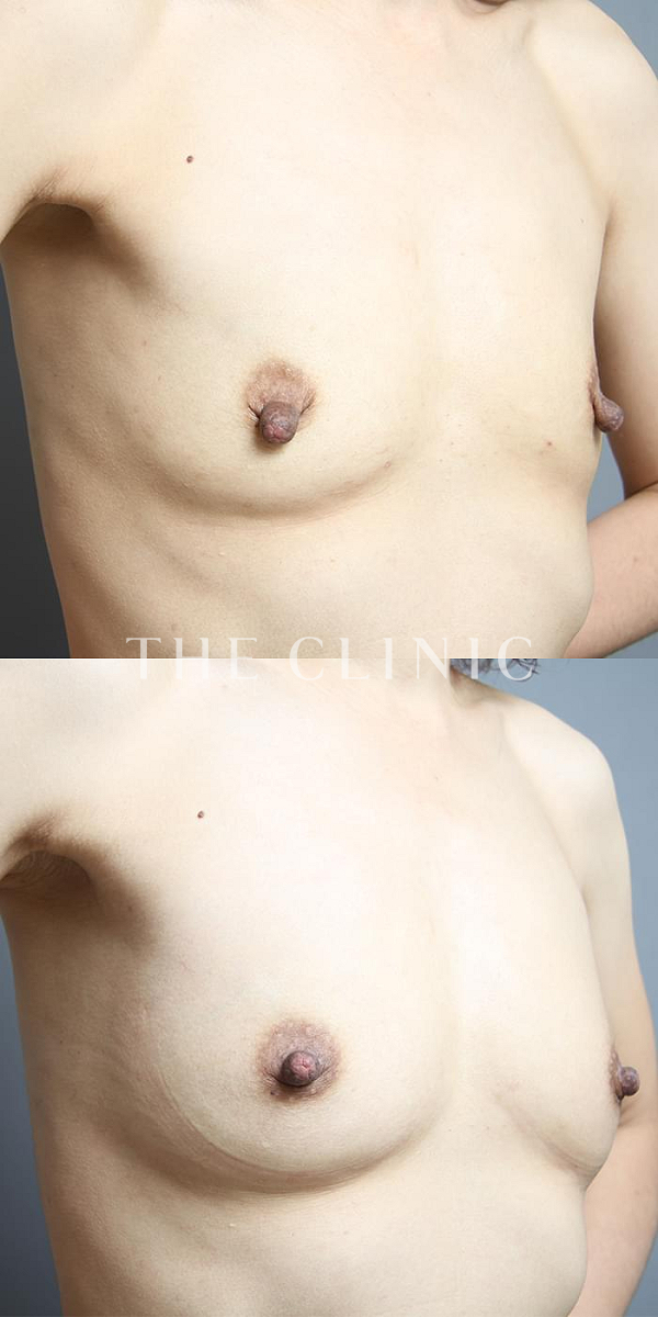 ボリュームアップのコンデンスリッチ豊胸（44歳女性）の術前・術後写真