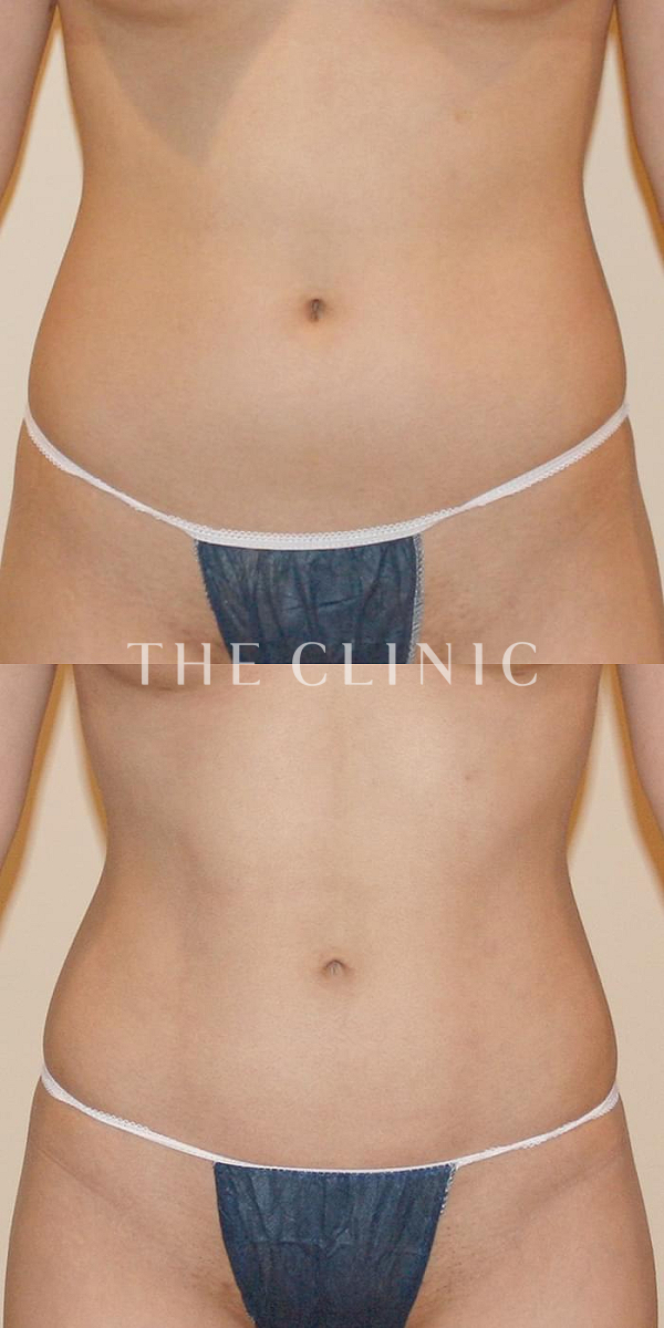 腹部の4D脂肪吸引(4Dリポ)（28歳女性）の術前・術後写真