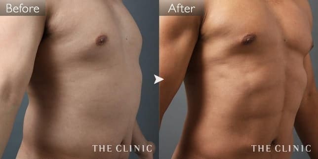 SIX PACK ６つに割れた腹筋（男性／45歳）