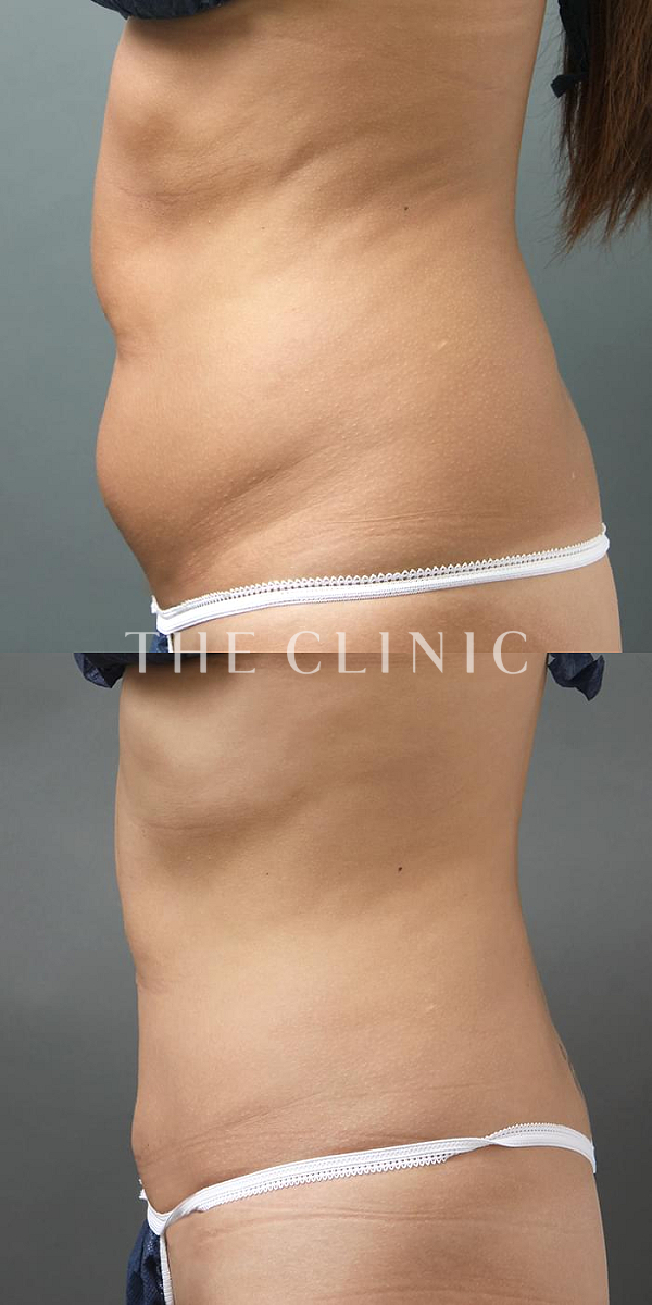 腹部のベイザー脂肪吸引（29歳女性）の術前・術後写真