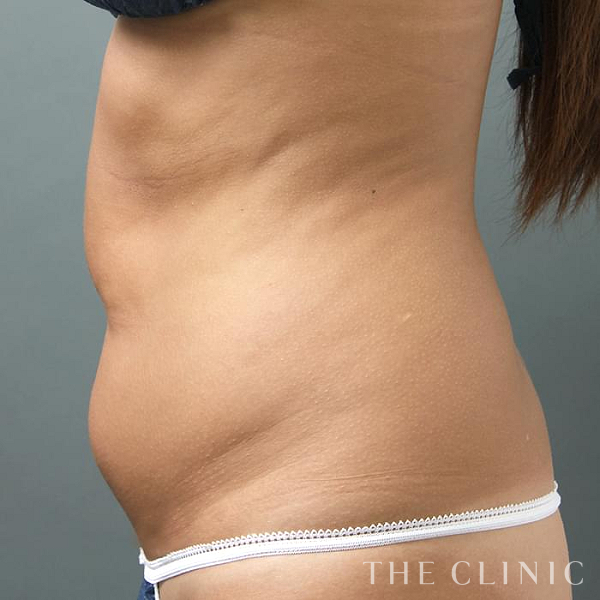 腹部のベイザー脂肪吸引（29歳女性）の術前写真