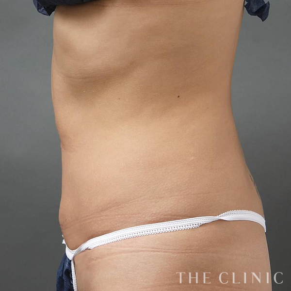 腹部のベイザー脂肪吸引（29歳女性）の術後写真