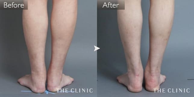 ふくらはぎ 症例写真