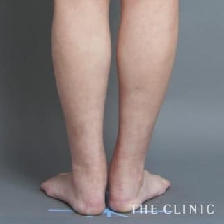 【THE CLINIC 症例画像】No.456_1_ふくらはぎ_1Day脂肪吸引(日帰りの脂肪吸引)